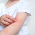 Child's arm showing skin irritation and redness