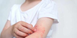 Child's arm showing skin irritation and redness