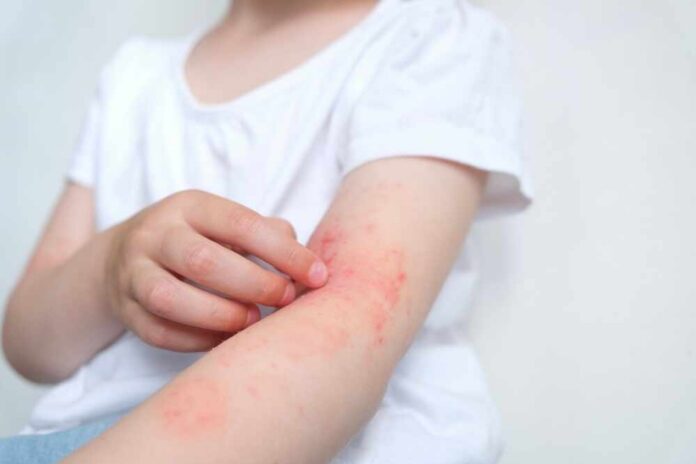 shutterstock_2169082807 (1).jpg Child's arm showing skin irritation and redness