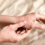Stress-Skin Link: Breakthrough Discovery Close-up of a person's hands showing skin irritation and redness