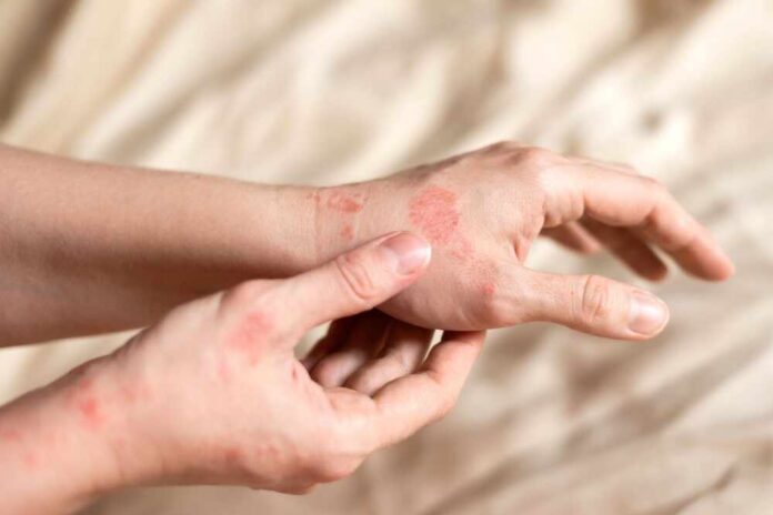 shutterstock_2226168387.jpg Close-up of a person's hands showing skin irritation and redness