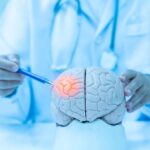 Alzheimer’s Breakthrough Without Costly Infusions Doctor examining a model of a brain with a pen