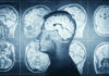 Hidden Brain Switch Could End Obesity Struggle MRI scans of the brain displayed alongside a silhouette of a human head