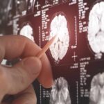 The Dementia Paradox: Why Are Women At Higher Risk? A hand pointing at a brain MRI scan on a screen
