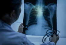 Silent Heart Clues Flag Cancer Years Early Doctor examining a chest X-ray with a stethoscope in hand