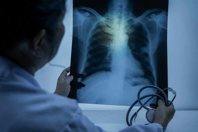 shutterstock_2482877961 Doctor examining a chest X-ray with a stethoscope in hand