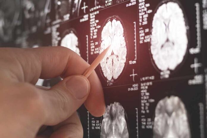 Doctor,Examining,Mri,,Mrt,,Ct,Scan,Image,Of,Human,Brain. A hand pointing at a brain MRI scan on a screen