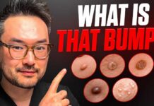Common Skin Growths Explained Lumps and Bumps On Your Skin | Dr. Danny Guo