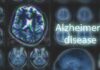Staggering Alzheimer’s Risk Gap: Women Blindsided Brain MRI scans with highlighted section and text overlay
