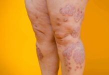 legs with scaly red skin patches